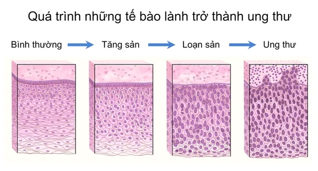 Hình 4. Minh họa quá trình những tế bào lành trở thành ung thư